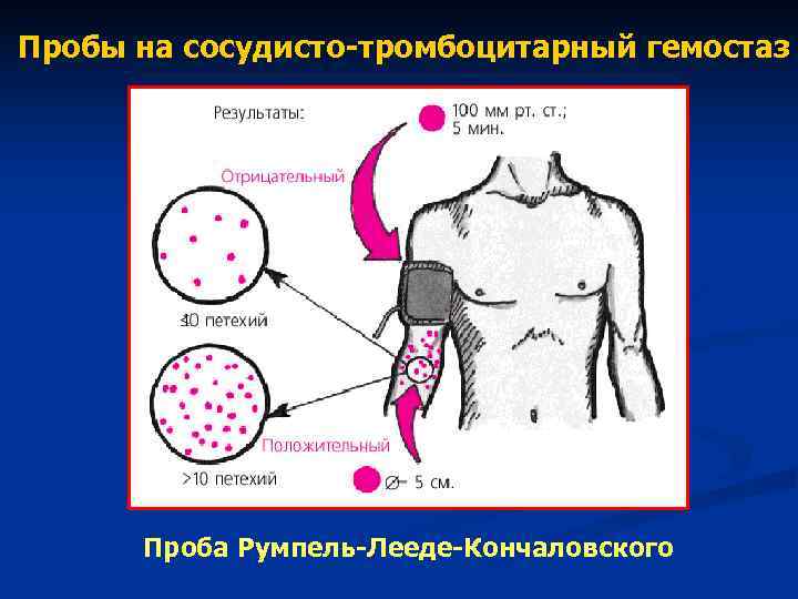 Пробы на сосудисто-тромбоцитарный гемостаз Проба Румпель-Лееде-Кончаловского Пробы на сосудисто-тромбоцитарный гемостаз Проба Румпель-Лееде-Кончаловского