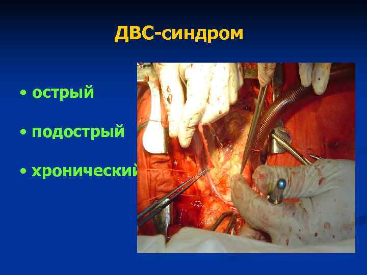 ДВС-синдром • острый • подострый • хронический ДВС-синдром • острый • подострый • хронический