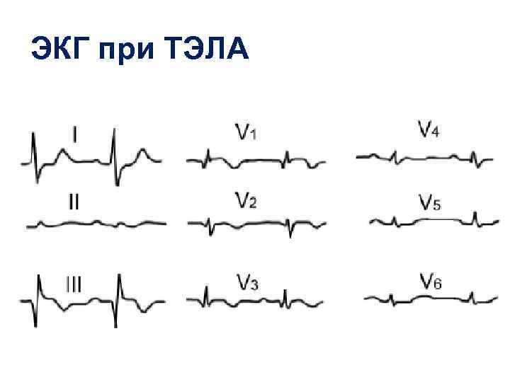 ЭКГ при ТЭЛА 