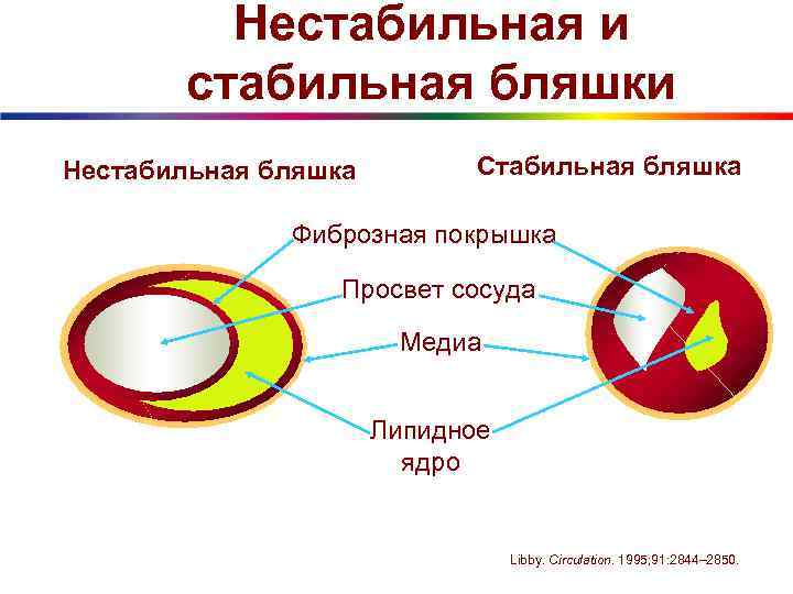 Стабильная атеросклеротическая бляшка. Нестабильность атеросклеротической бляшки. Строение стабильной атеросклеротической бляшки. Строение стабильной и нестабильной атеросклеротической бляшки. Нестабильная атеросклеротическая бляшка.