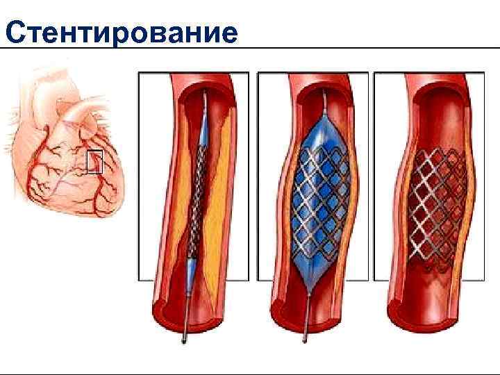 Стентирование 