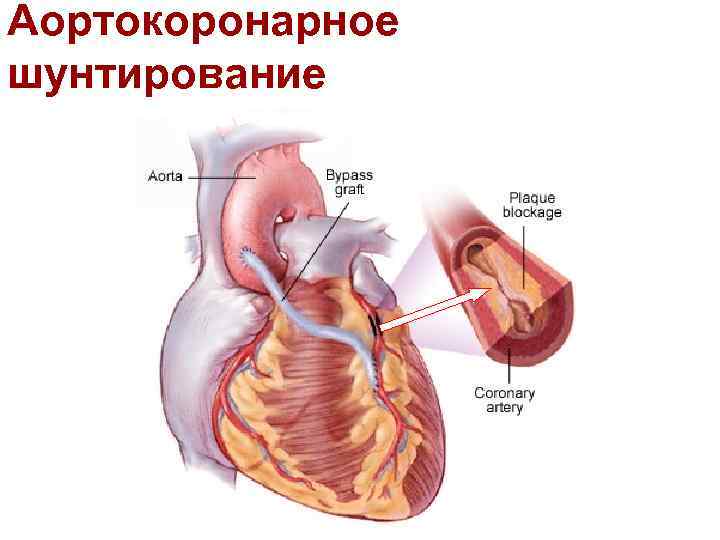 Аортокоронарное шунтирование 