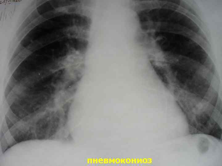 пневмокониоз 