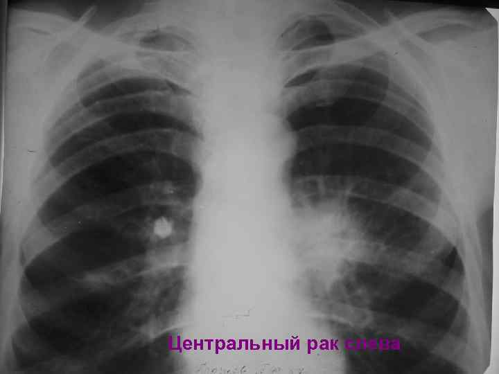 Центральный рак слева 