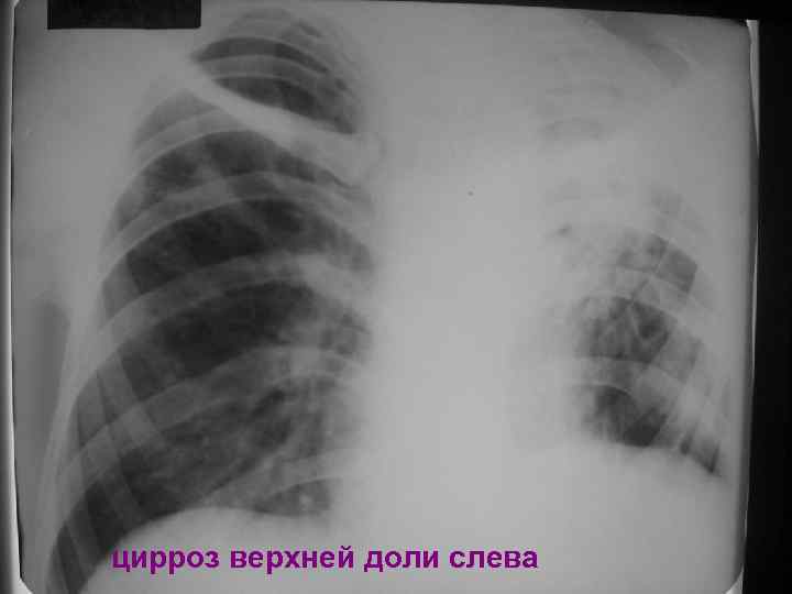 цирроз верхней доли слева 