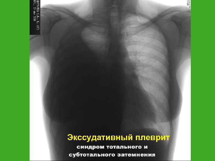 Экссудативный плеврит 