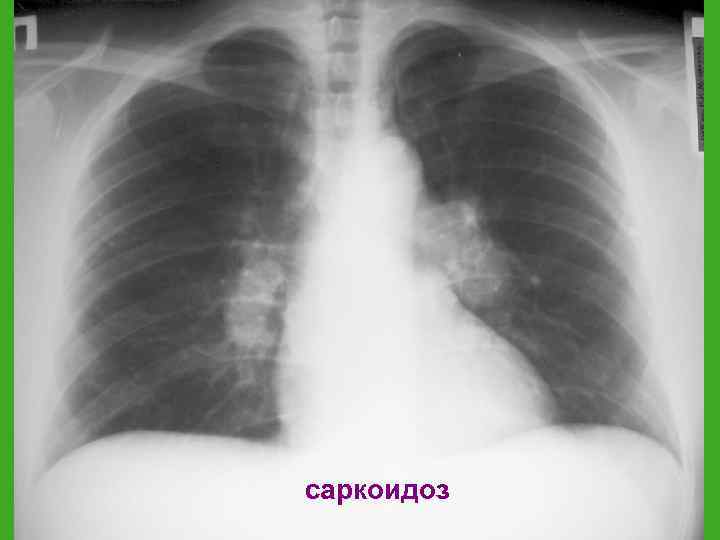 саркоидоз 