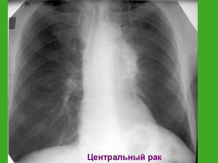 Центральный рак 