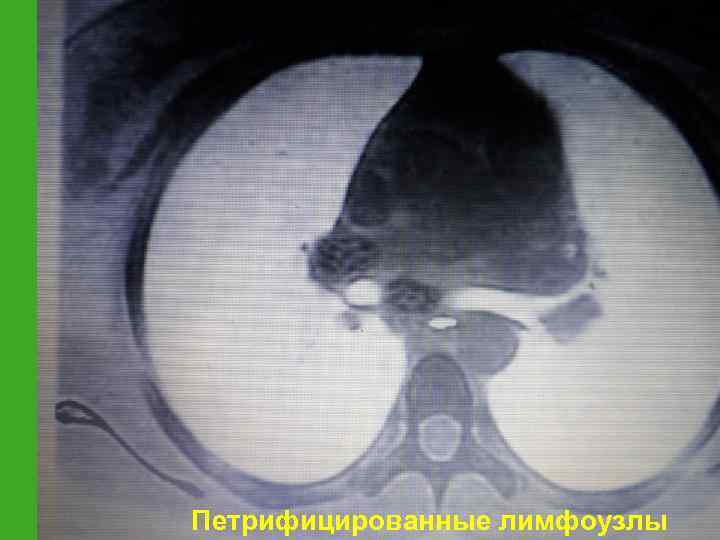Петрифицированные лимфоузлы 
