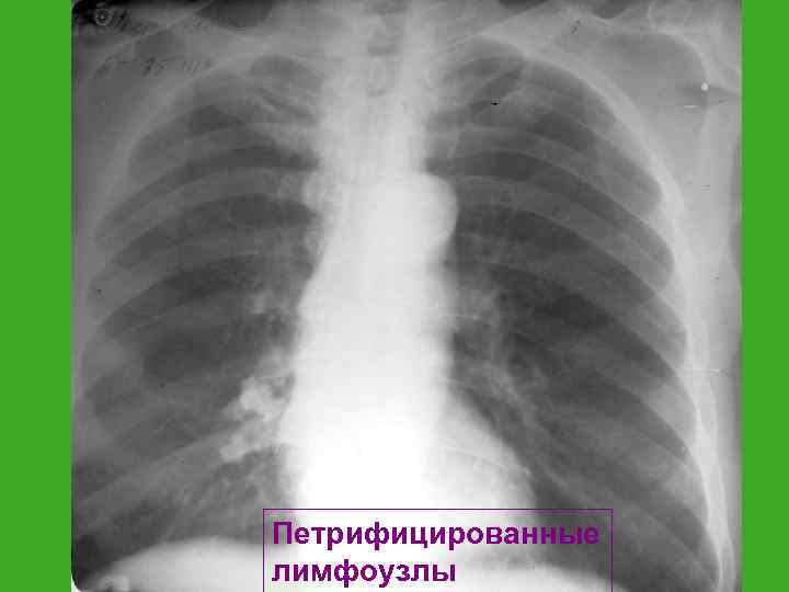 Петрифицированные лимфоузлы 