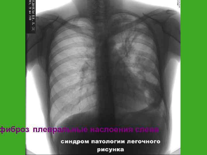 фиброз плевральные наслоения слева 