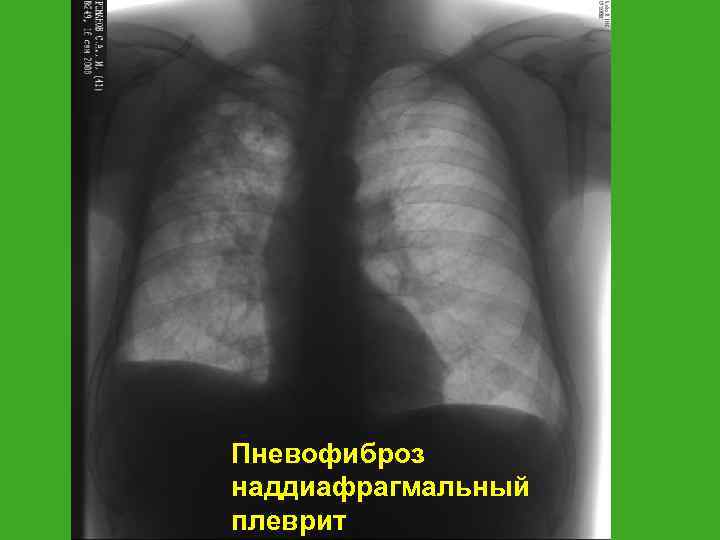 Пневофиброз наддиафрагмальный плеврит 