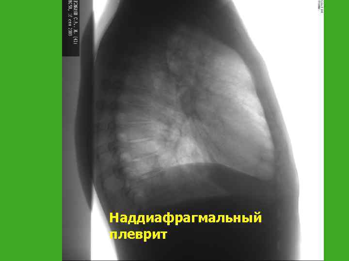 Наддиафрагмальный плеврит 