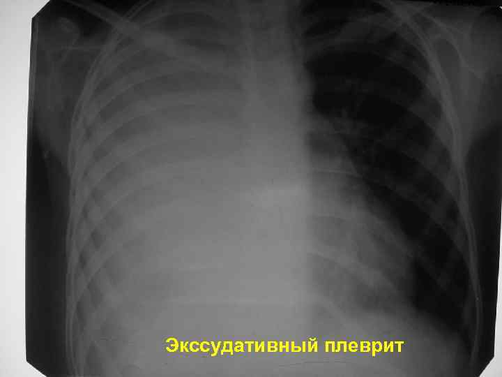 Экссудативный плеврит 