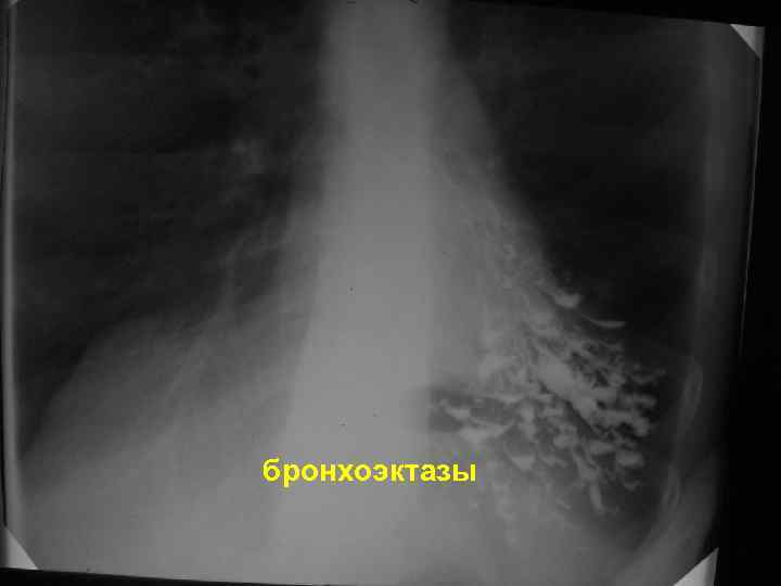 бронхоэктазы 