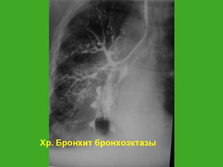 Хр. Бронхит бронхоэктазы 