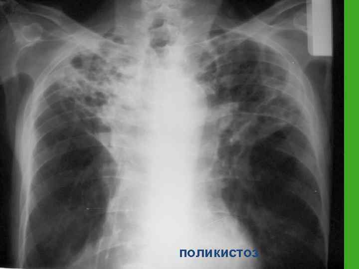 поликистоз 