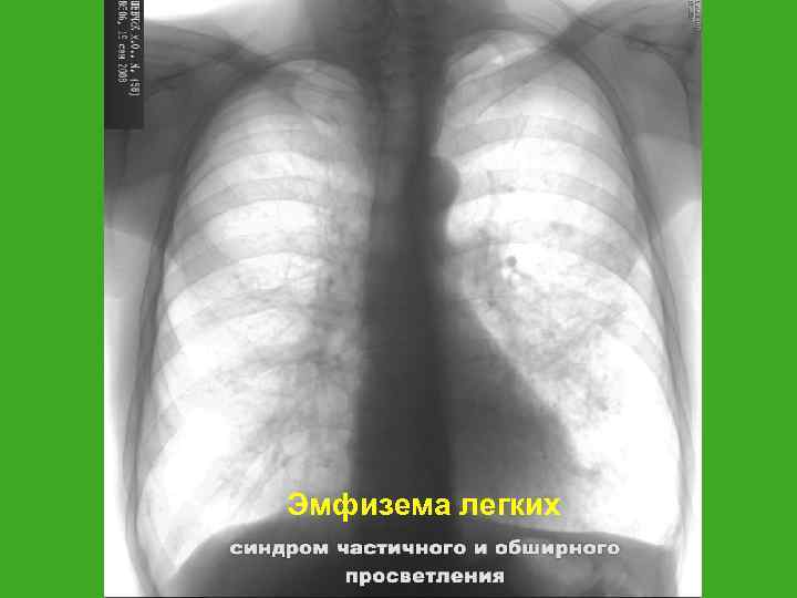Эмфизема легких 