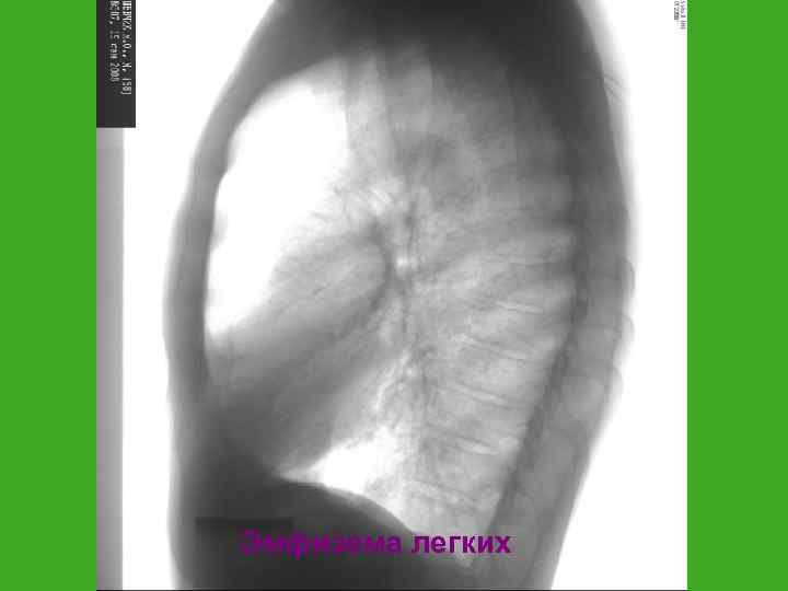 Эмфизема легких 