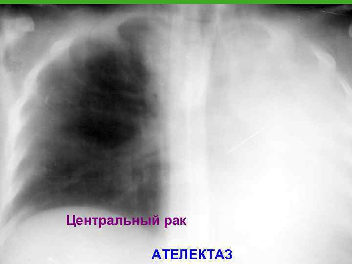 Центральный рак АТЕЛЕКТАЗ 