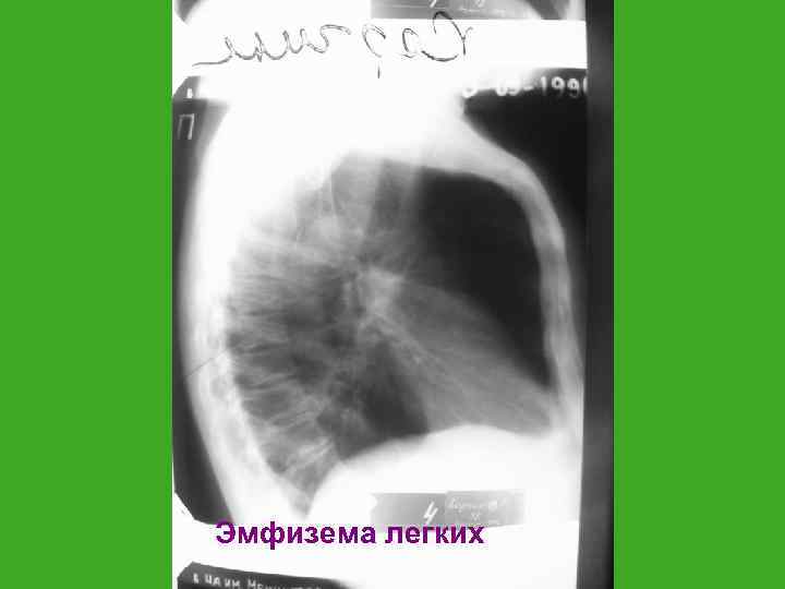Эмфизема легких 