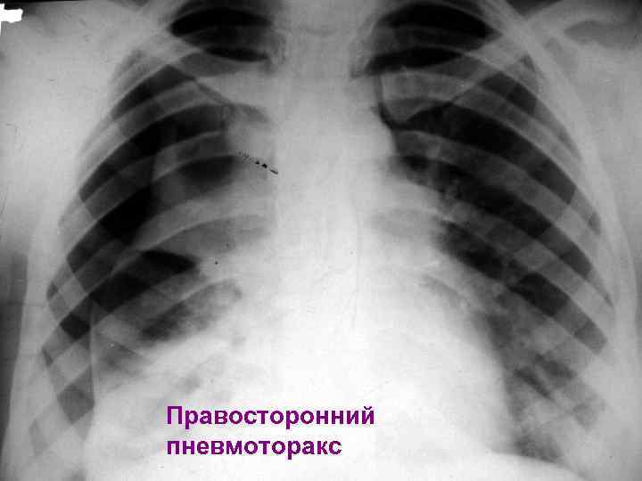 Правосторонний пневмоторакс 