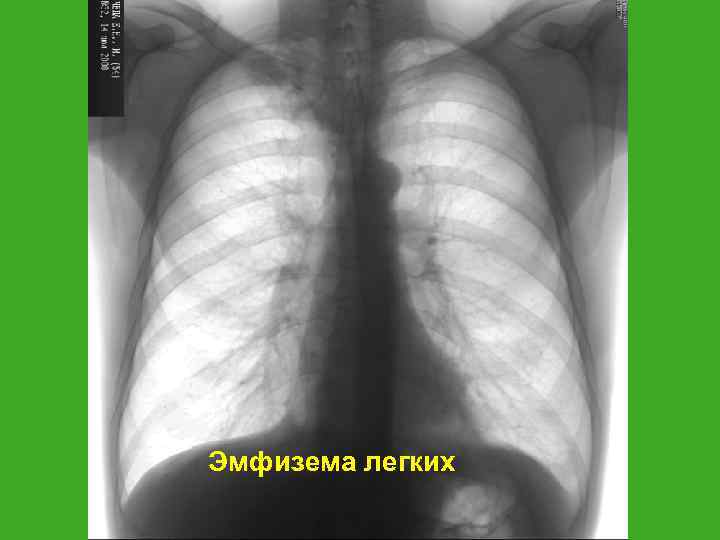 Рентгенологически при эмфиземе легочный рисунок