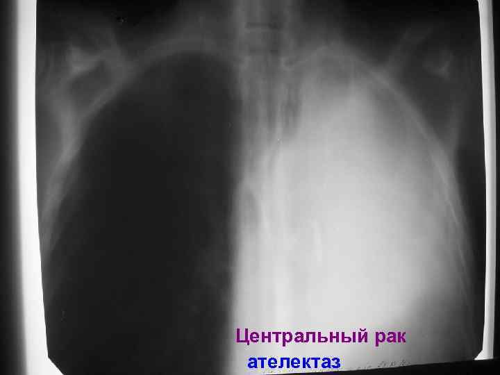 Центральный рак ателектаз 