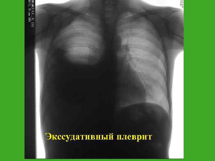 Экссудативный плеврит 
