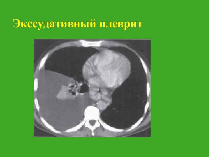 Экссудативный плеврит 
