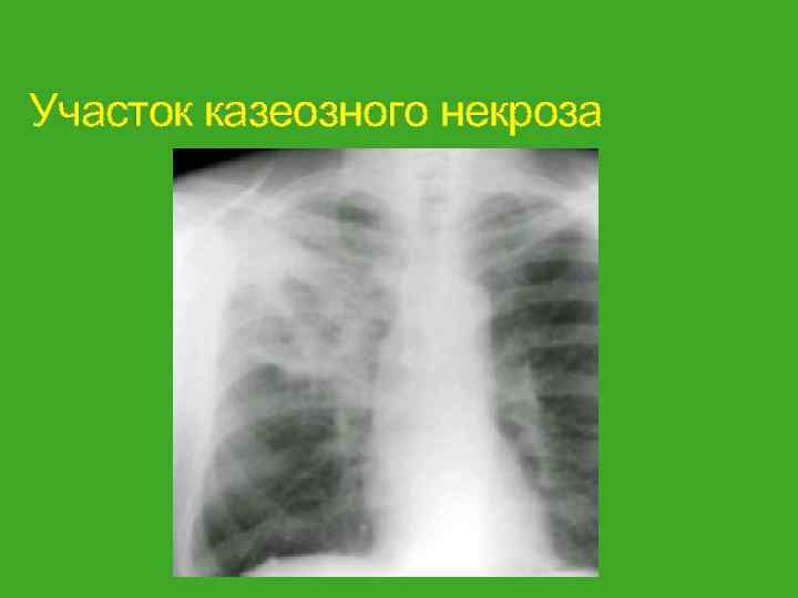 Участок казеозного некроза 