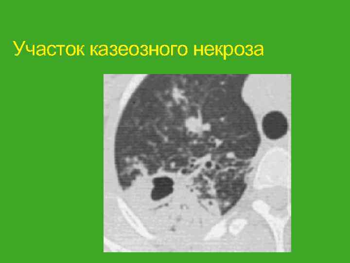Участок казеозного некроза 
