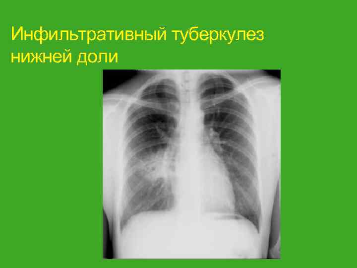 Инфильтративный туберкулез нижней доли 