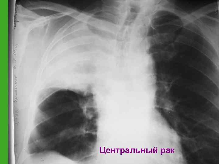 Центральный рак 