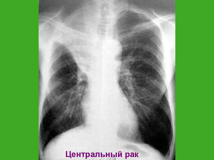 Центральный рак 