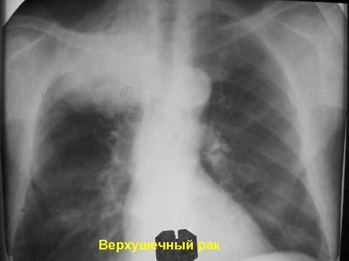 Верхушечный рак 