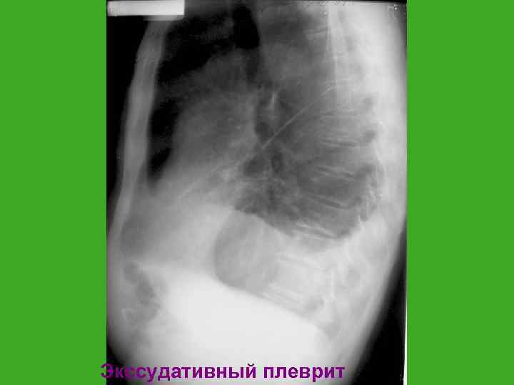 Экссудативный плеврит 