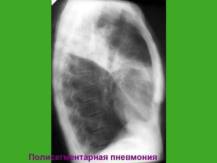 Полисегментарная пневмония 