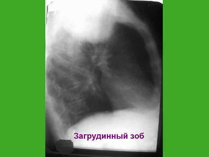 Загрудинный зоб 