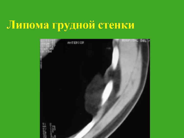 Липома грудной стенки 