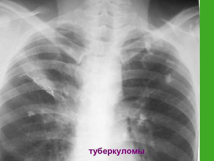туберкуломы 