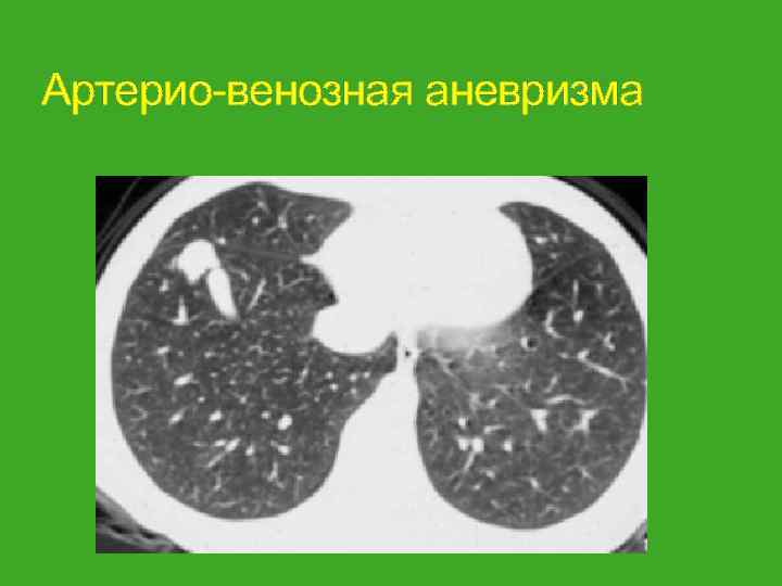 Артерио-венозная аневризма 