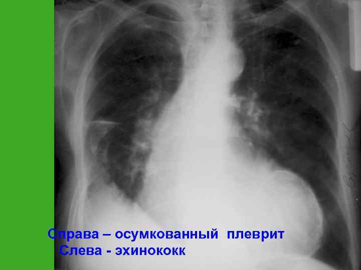 Справа – осумкованный плеврит Слева - эхинококк 