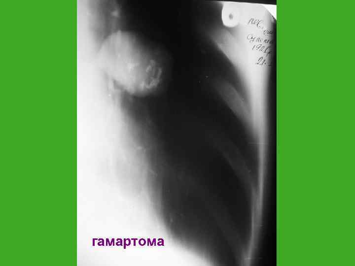 гамартома 