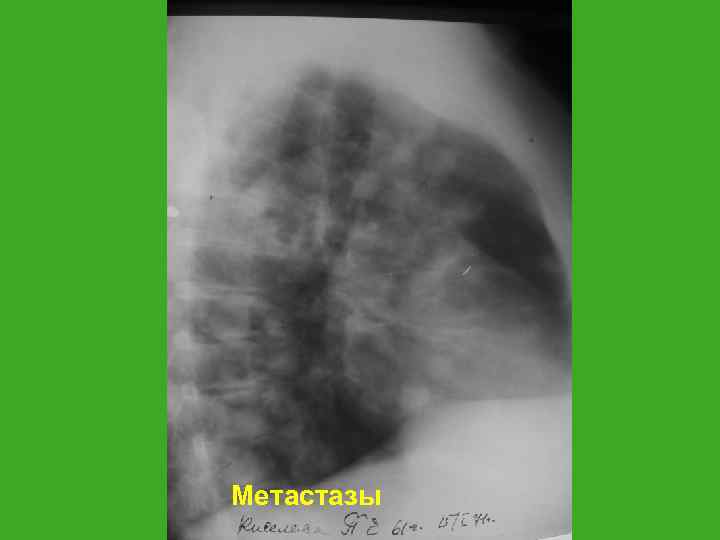 Метастазы 