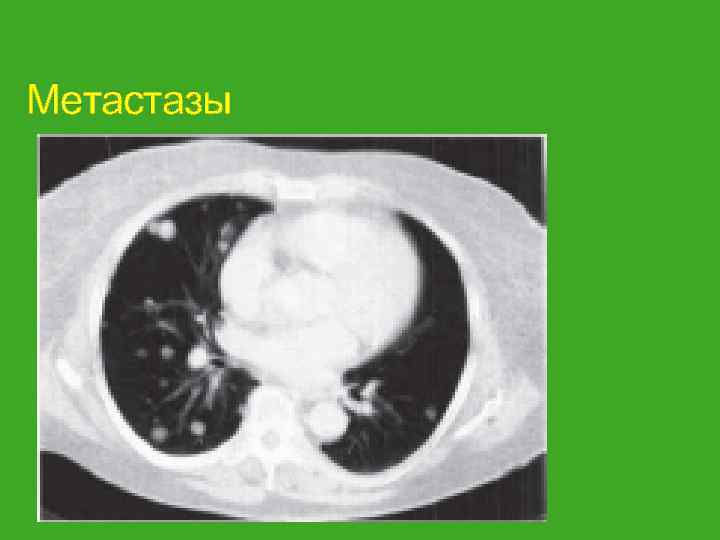 Метастазы 