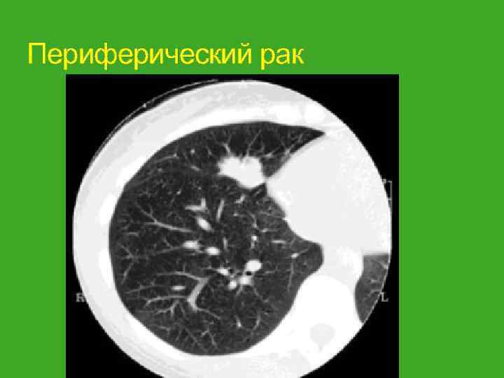 Периферический рак 
