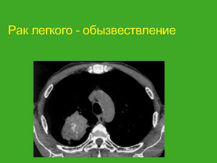 Рак легкого - обызвествление 