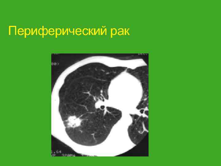 Периферический рак 