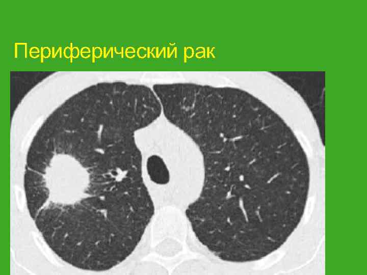 Периферический рак 